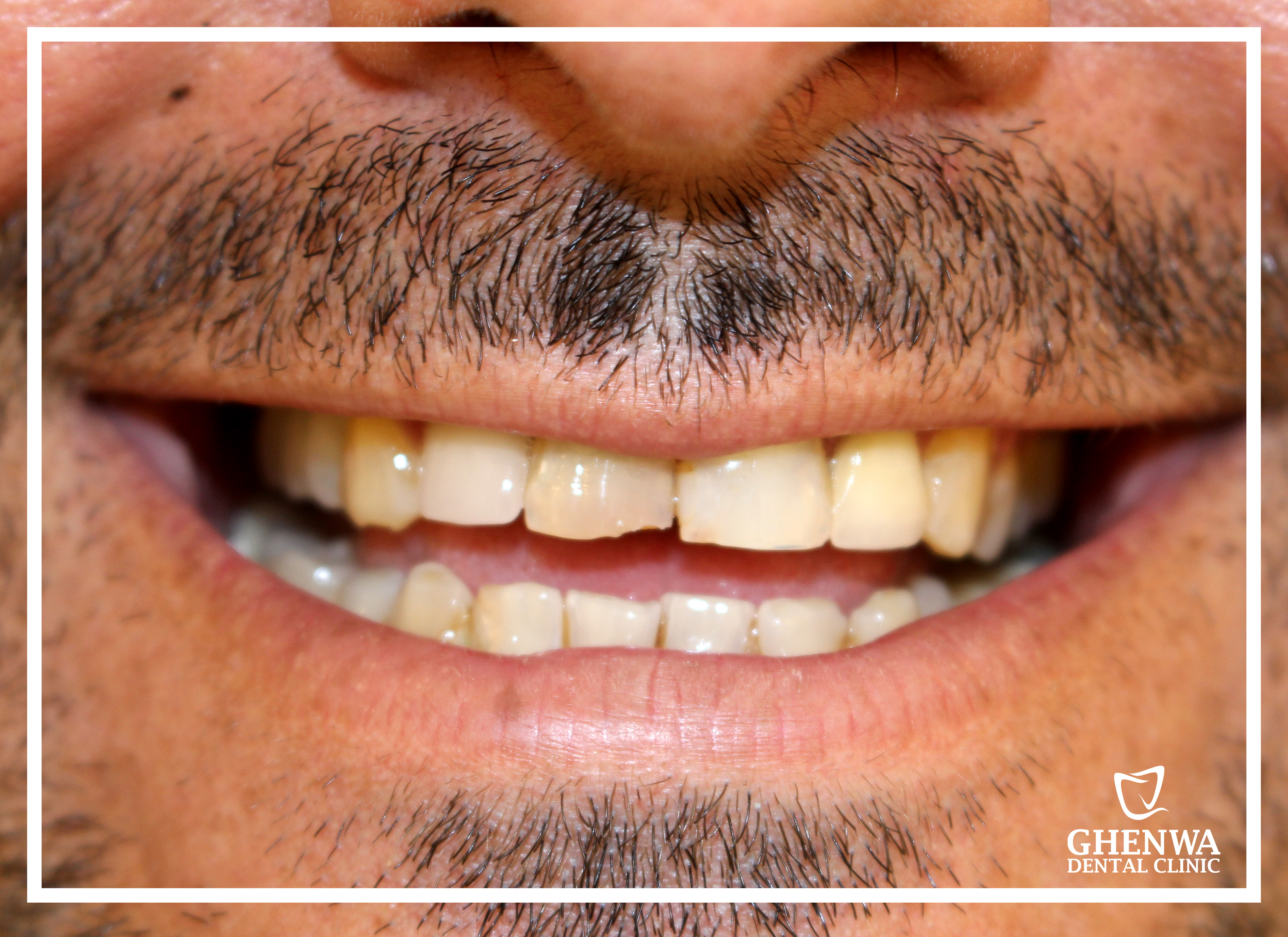 Before dental treatment